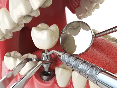 South Jersey Dental Implants