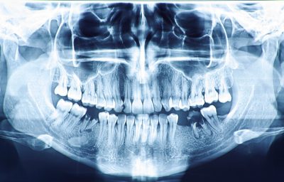 Dental Checkups, X-Rays and Cleanings