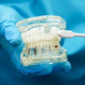 all-on-4-tooth-replacement"